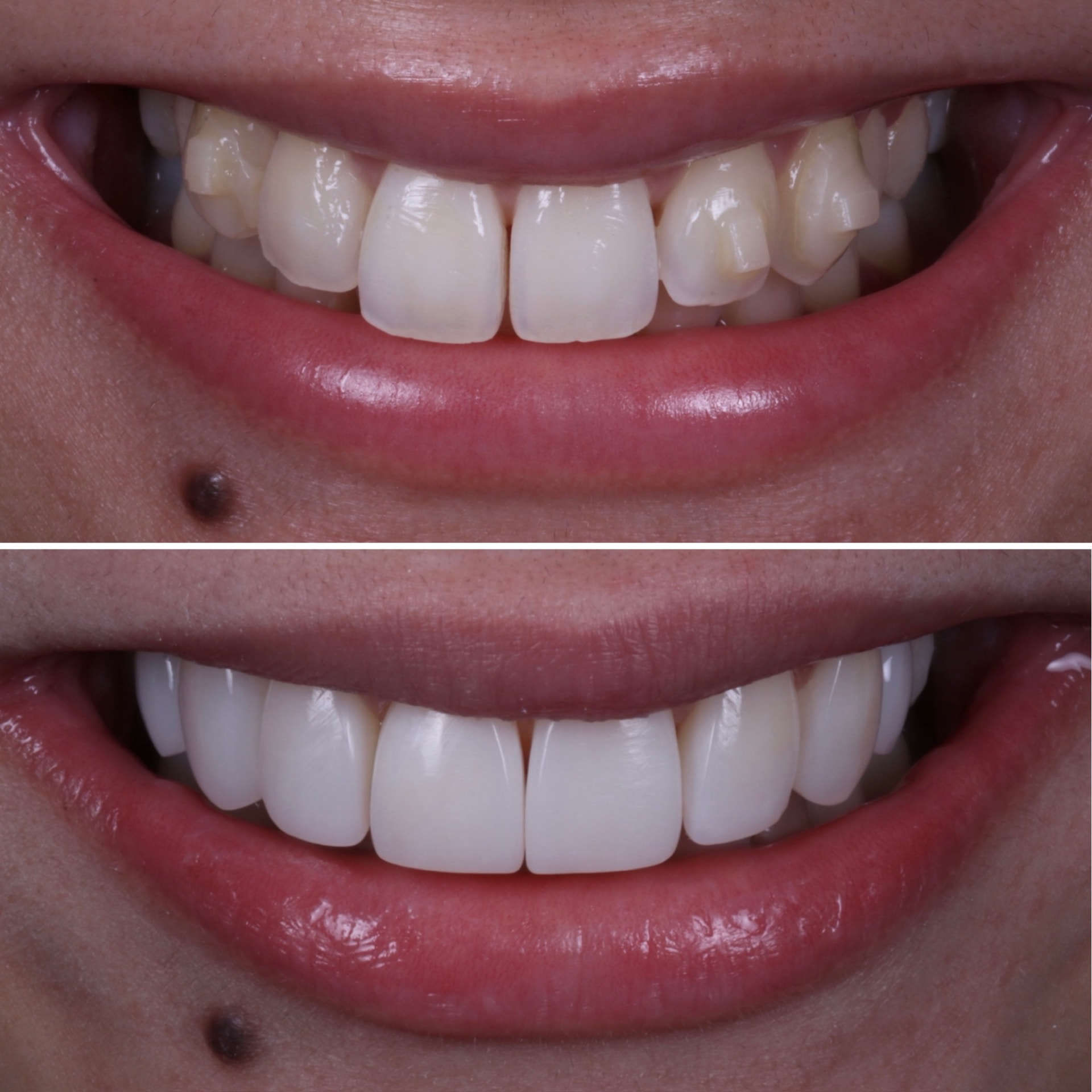 Before and after clear aligners + composite veneers at Batley Carr Dental Centre — real patient case 2