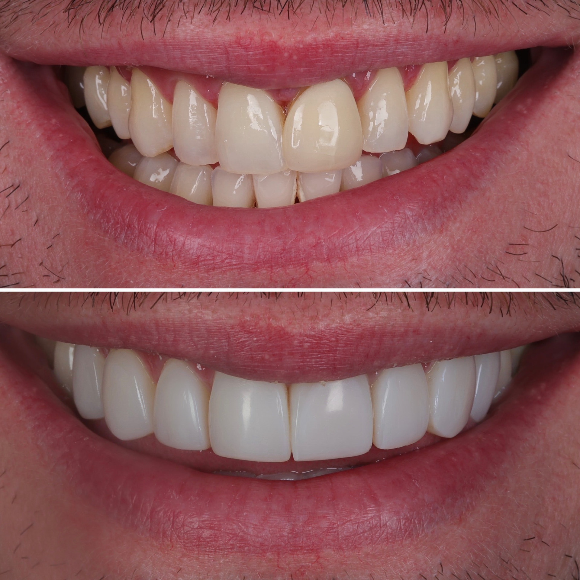 Before and after clear aligners + composite veneers at Batley Carr Dental Centre — real patient case 5