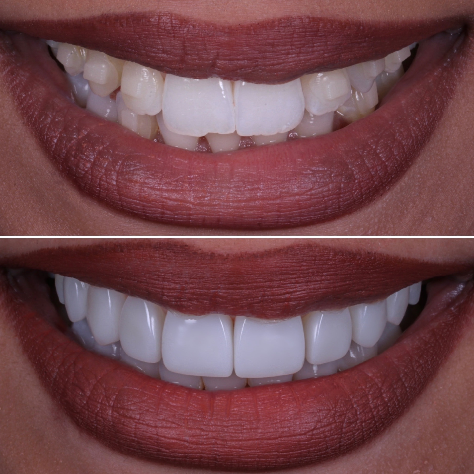 Before and after clear aligners + composite veneers at Batley Carr Dental Centre — real patient case 10