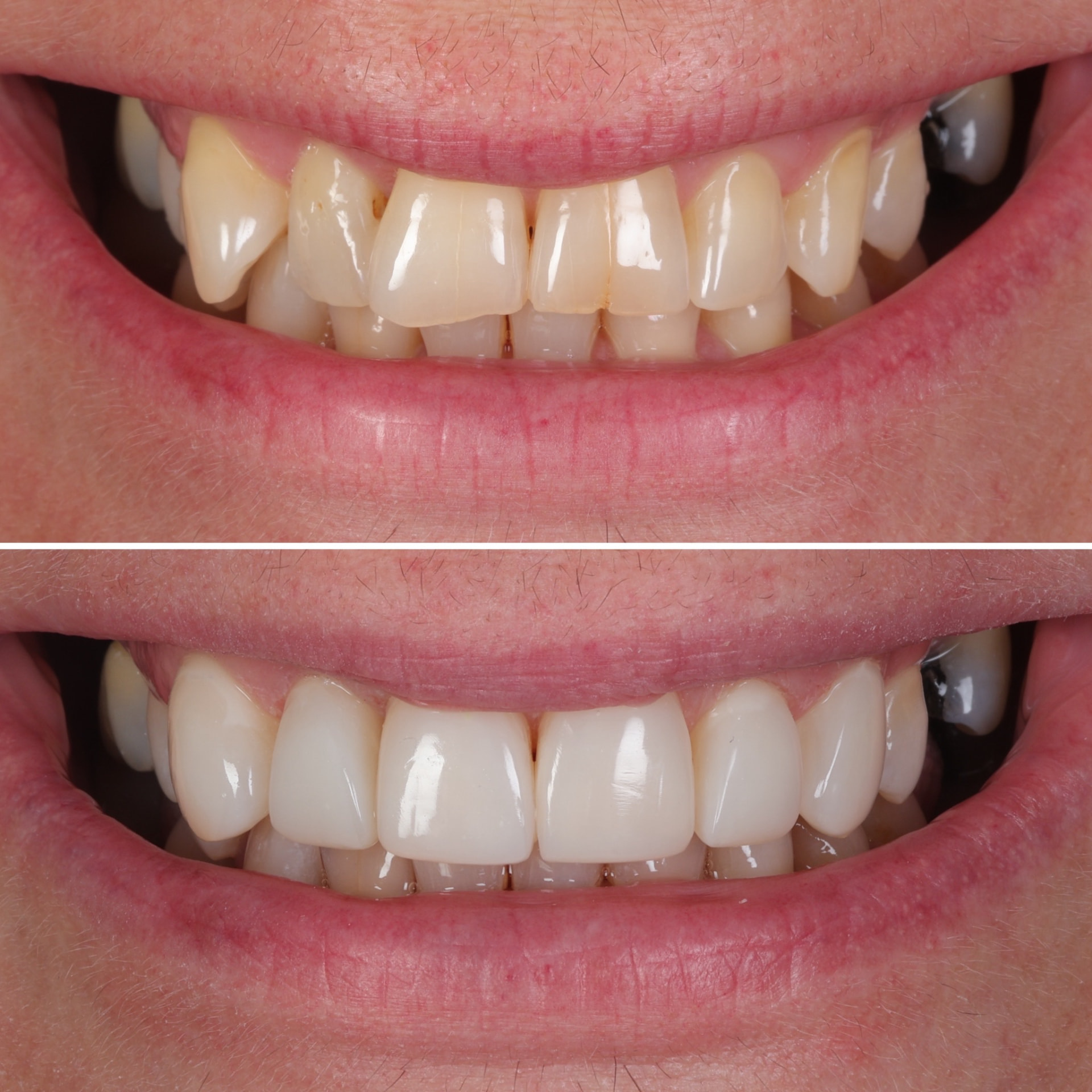 Before and after clear aligners + composite veneers at Batley Carr Dental Centre — real patient case 8