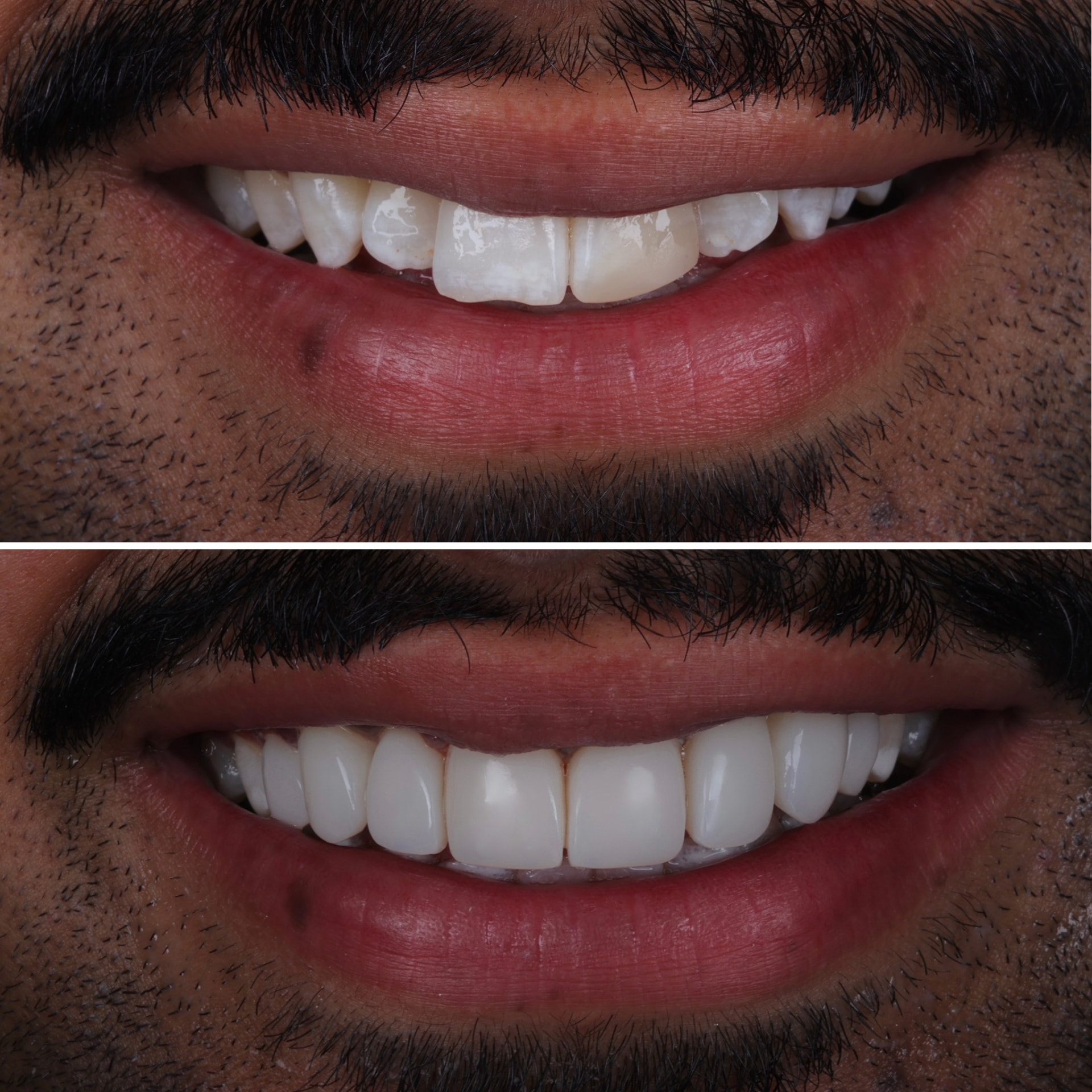 Before and after clear aligners + composite veneers at Batley Carr Dental Centre — real patient case 9