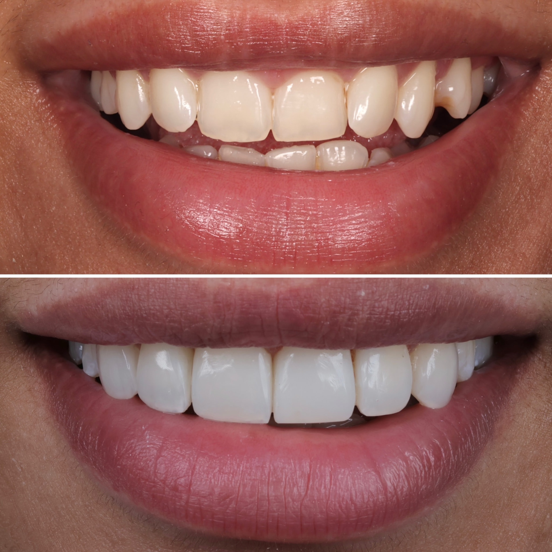Before and after composite veneers at Batley Carr Dental Centre — real patient case 1
