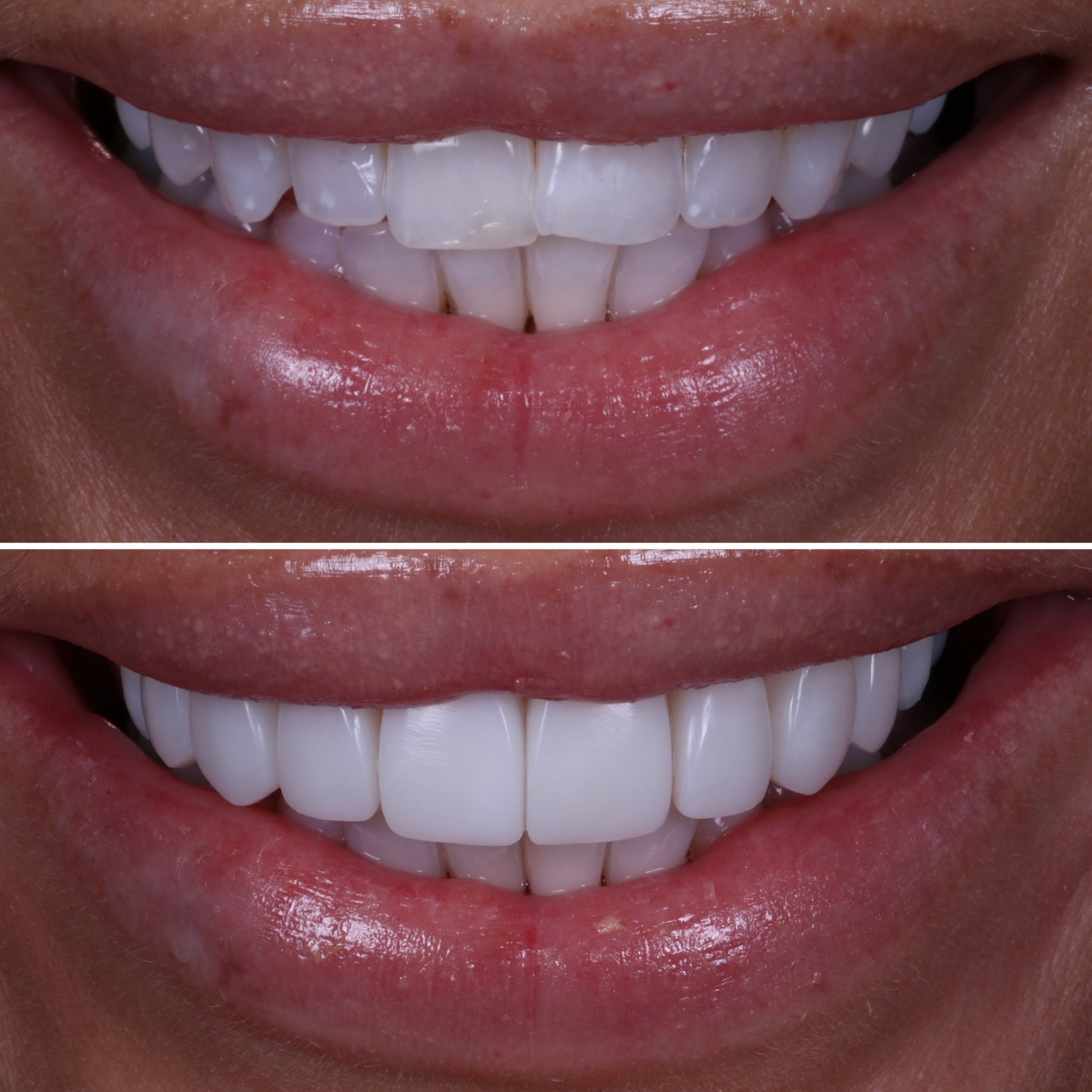 Before and after composite veneers at Batley Carr Dental Centre — real patient case 3