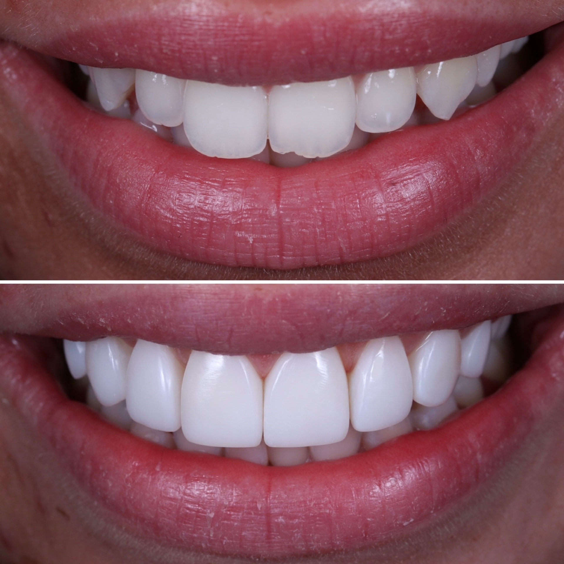 Before and after composite veneers at Batley Carr Dental Centre — real patient case 6