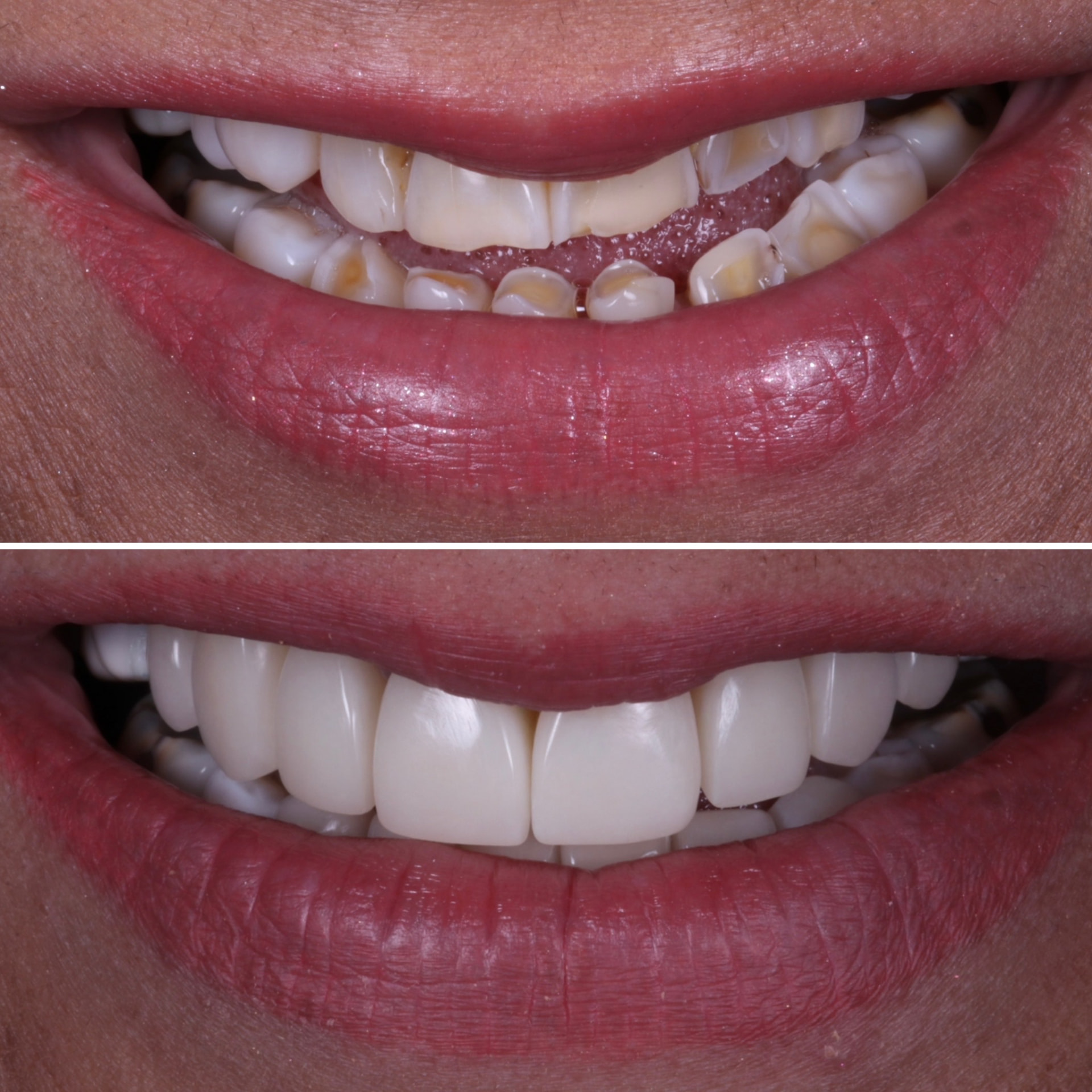 Before and after composite veneers at Batley Carr Dental Centre — real patient case 7