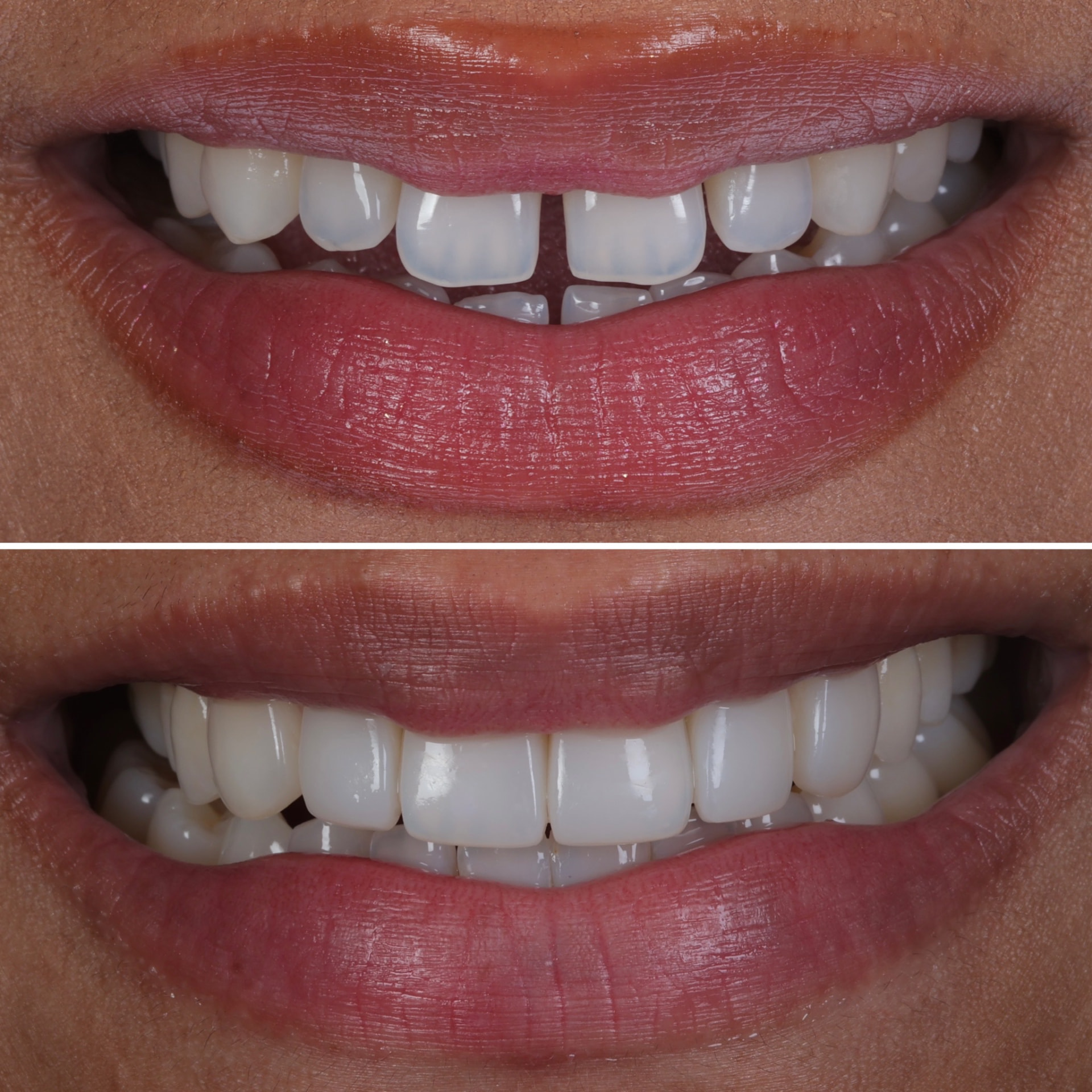 Before and after clear aligners + composite veneers at Batley Carr Dental Centre — real patient case 4
