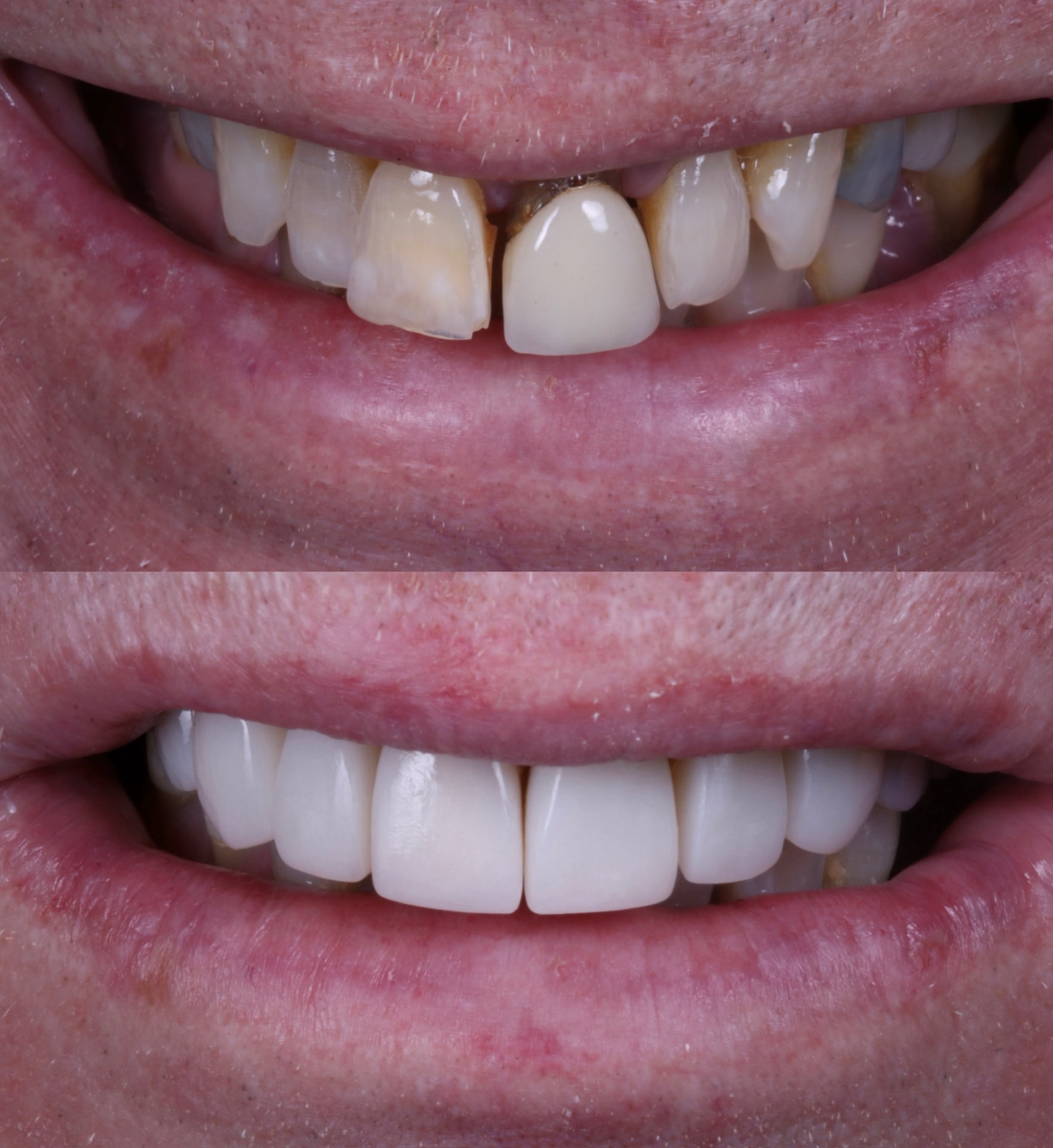 Real patient before and after composite bonding at Batley Carr Dental — case 1
