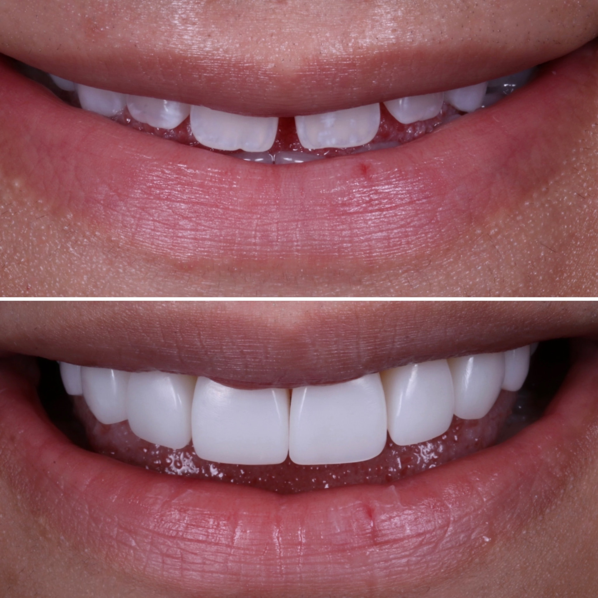 Real patient before and after composite bonding at Batley Carr Dental — case 2
